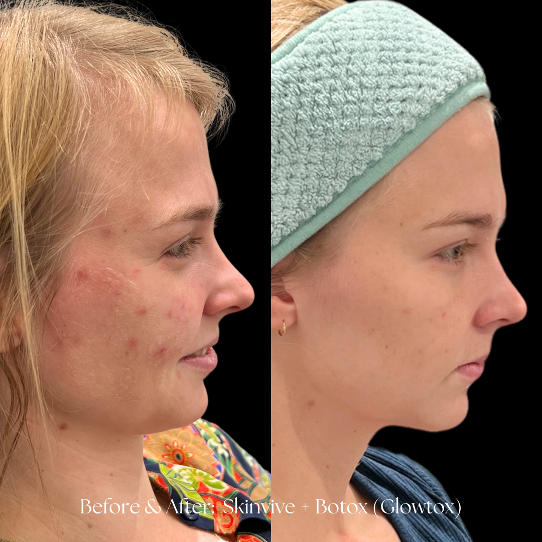 SKINVIVE Before & After