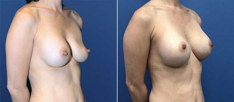 Nipple Reduction Before & After