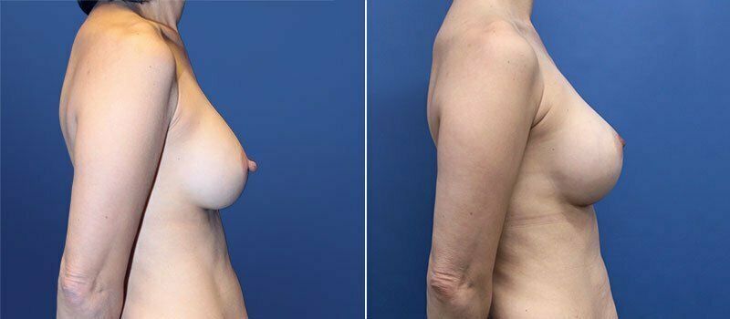 Nipple Reduction Before & After
