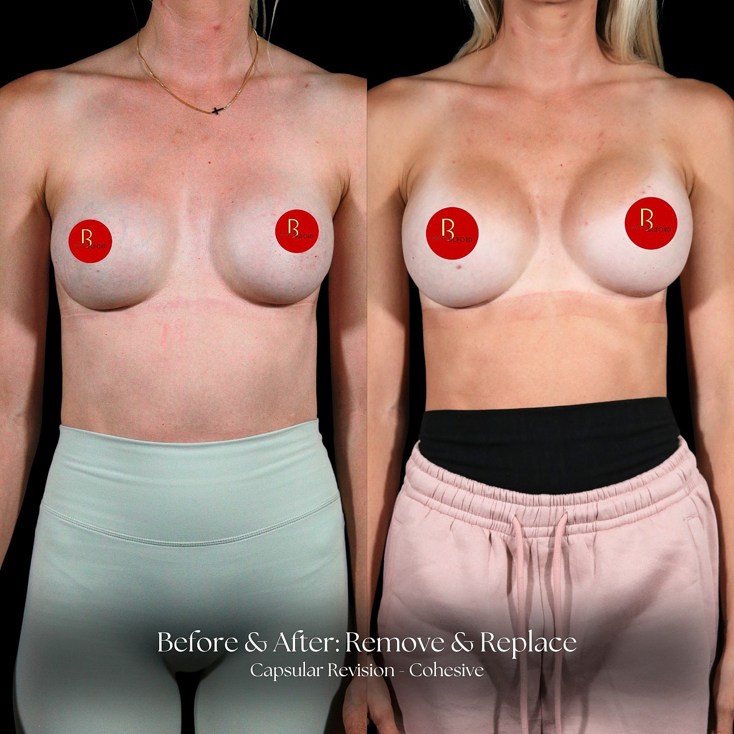 Capsular Revision Before & After