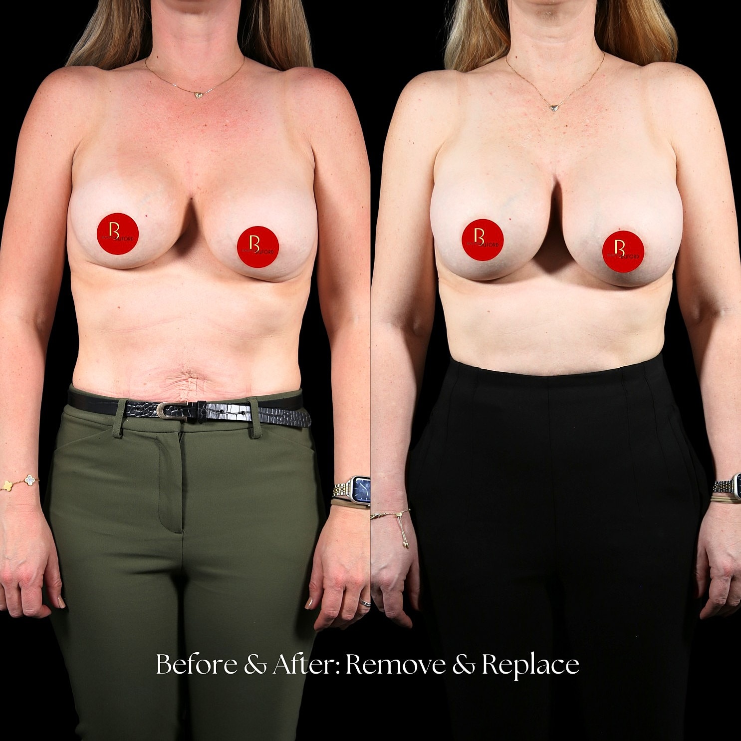 Capsular Revision Before & After