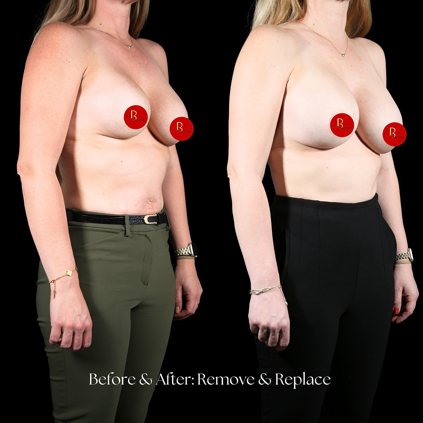 Capsular Revision Before & After