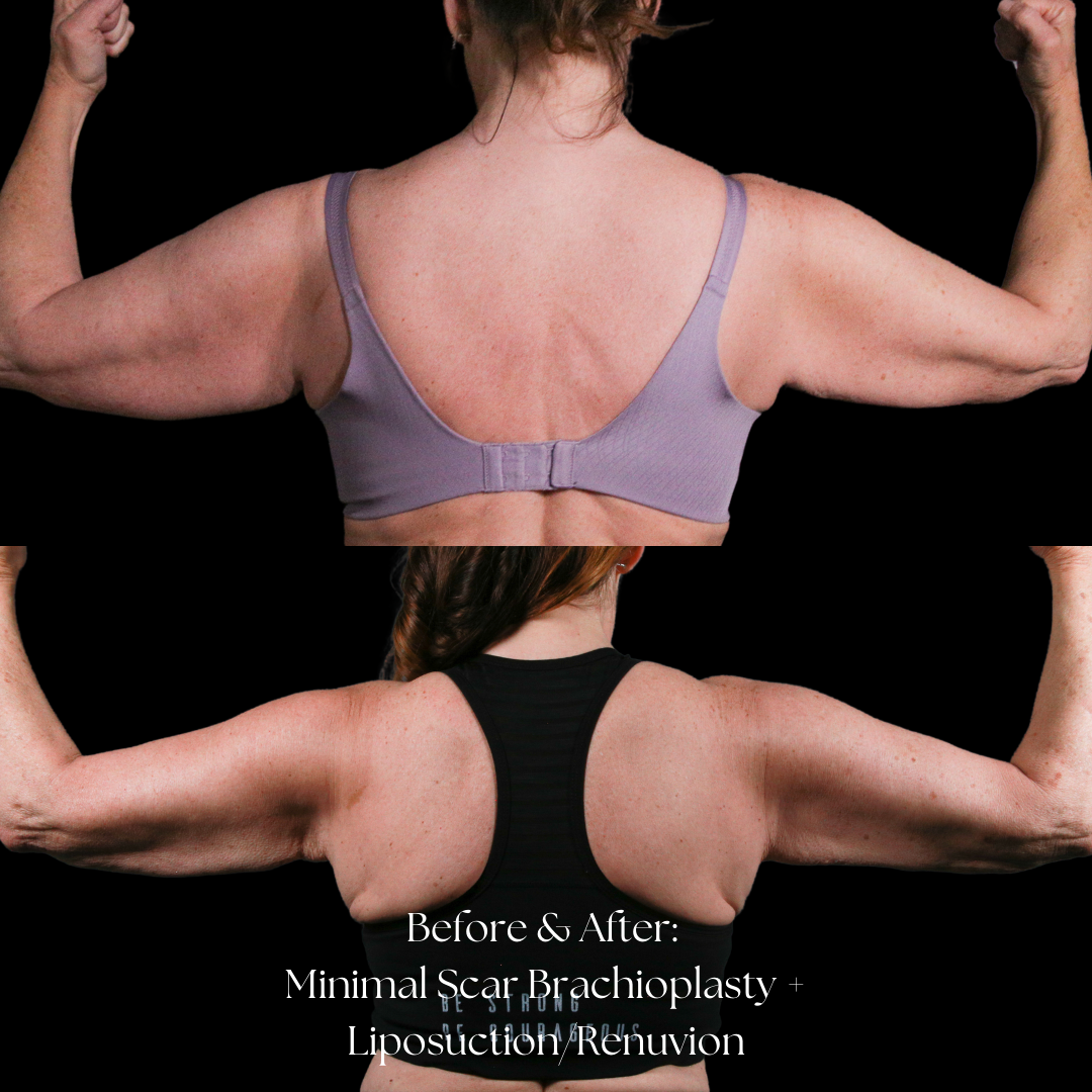 Arm Lift Before & After