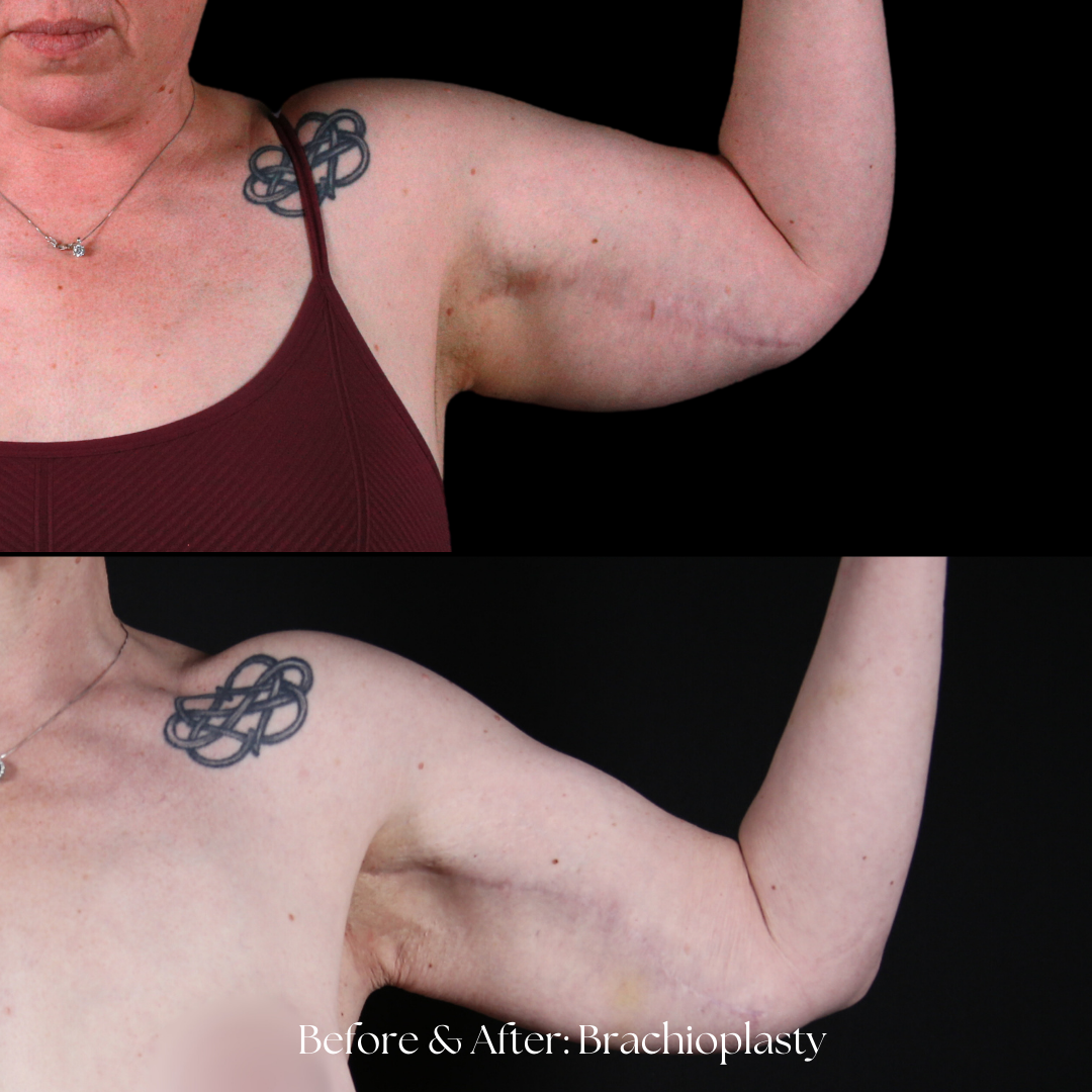 Arm Lift Before & After