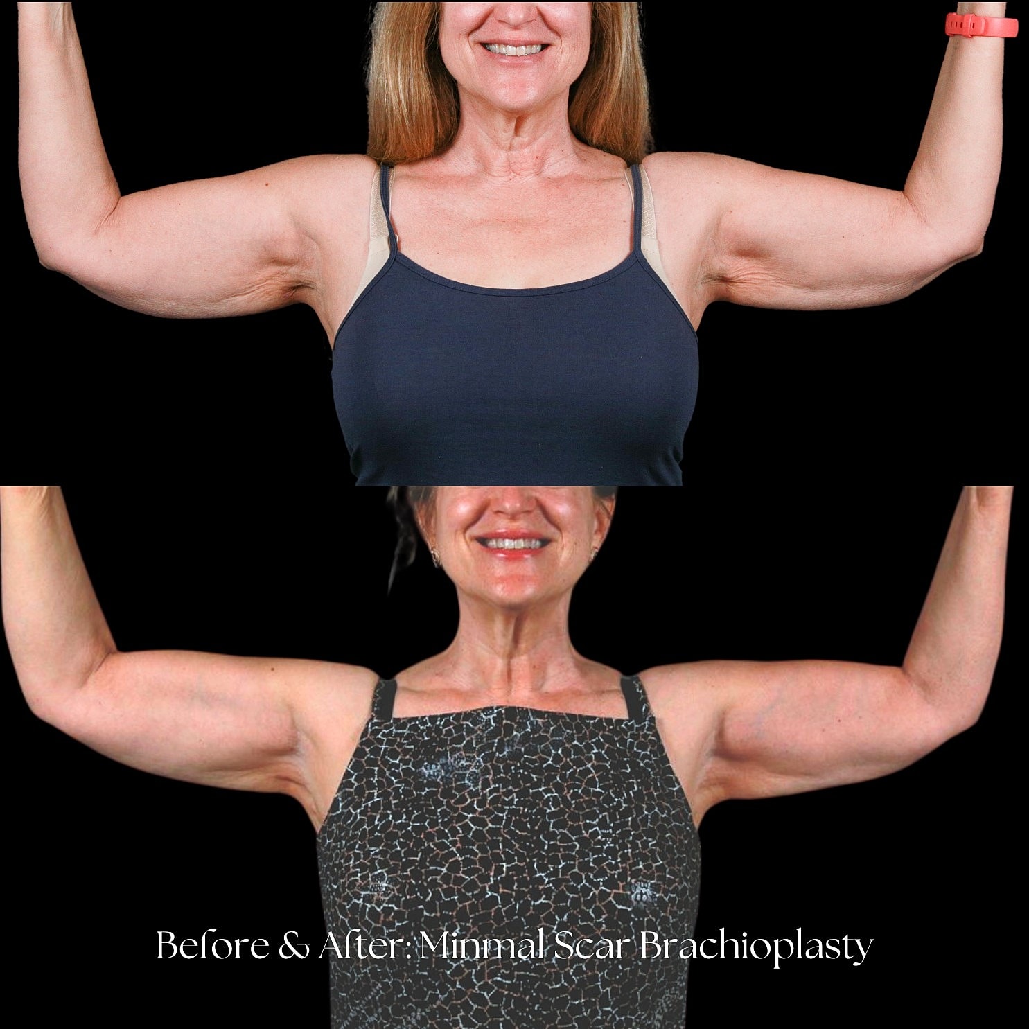 Arm Lift Before & After