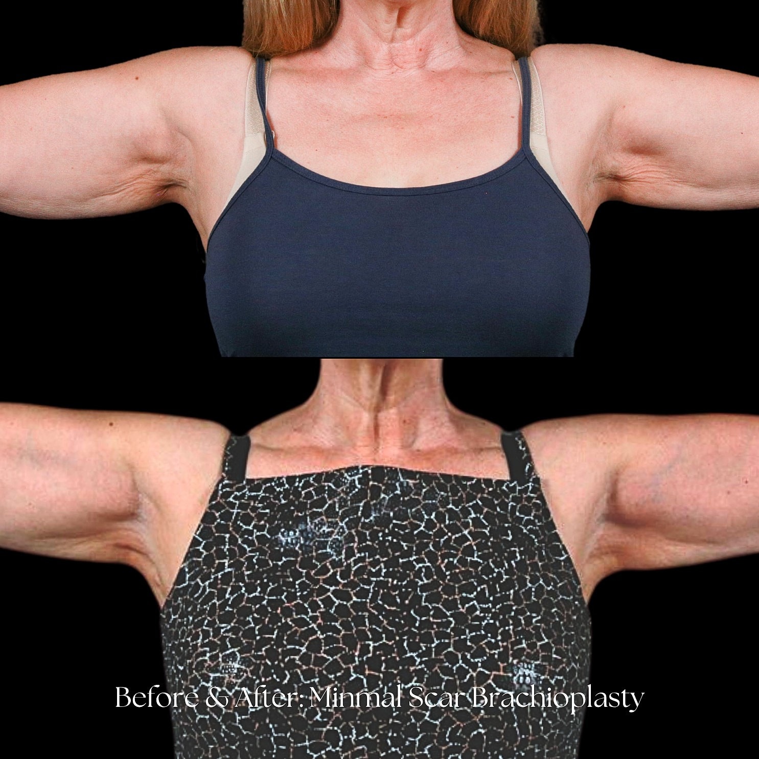 Arm Lift Before & After