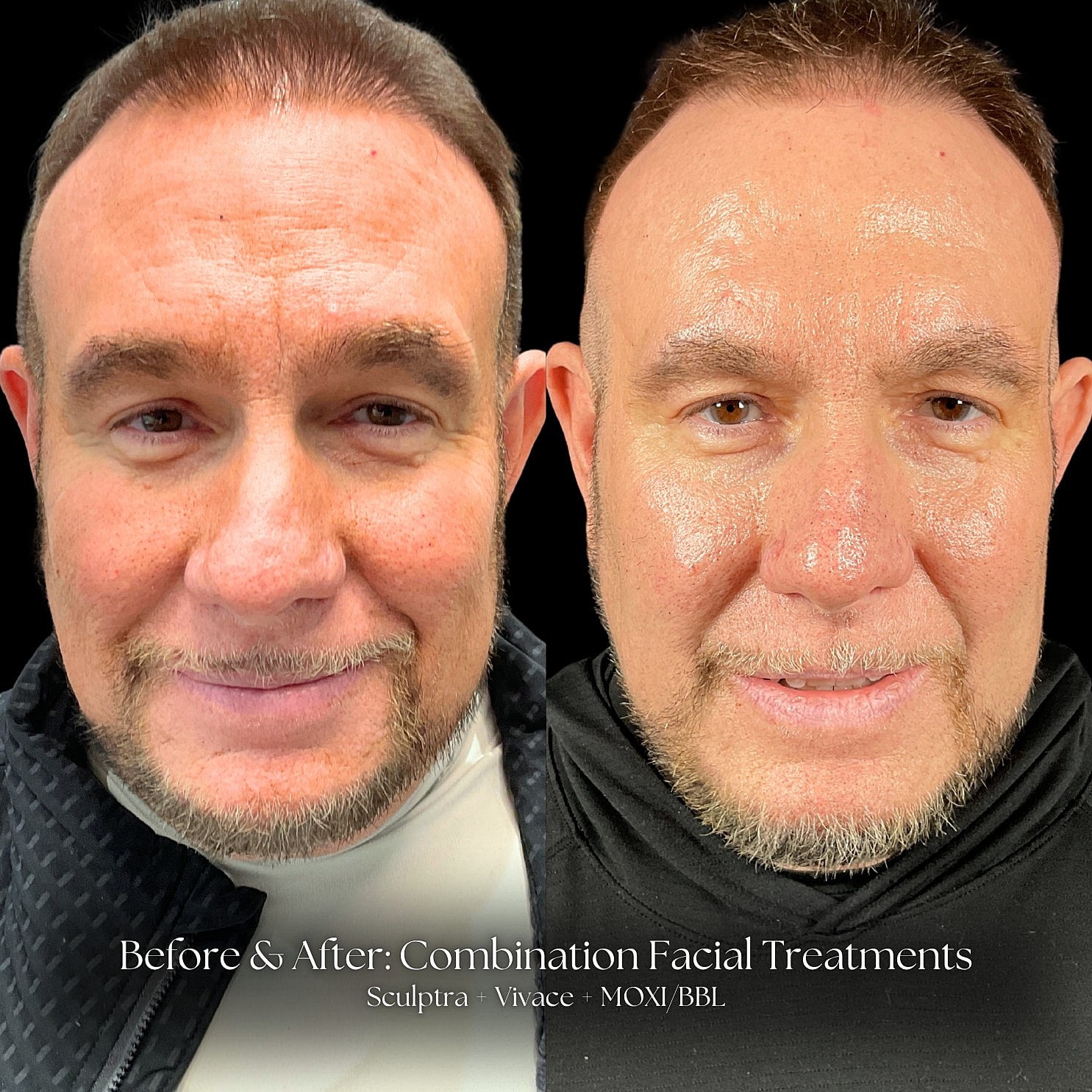 Sculptra Before & After