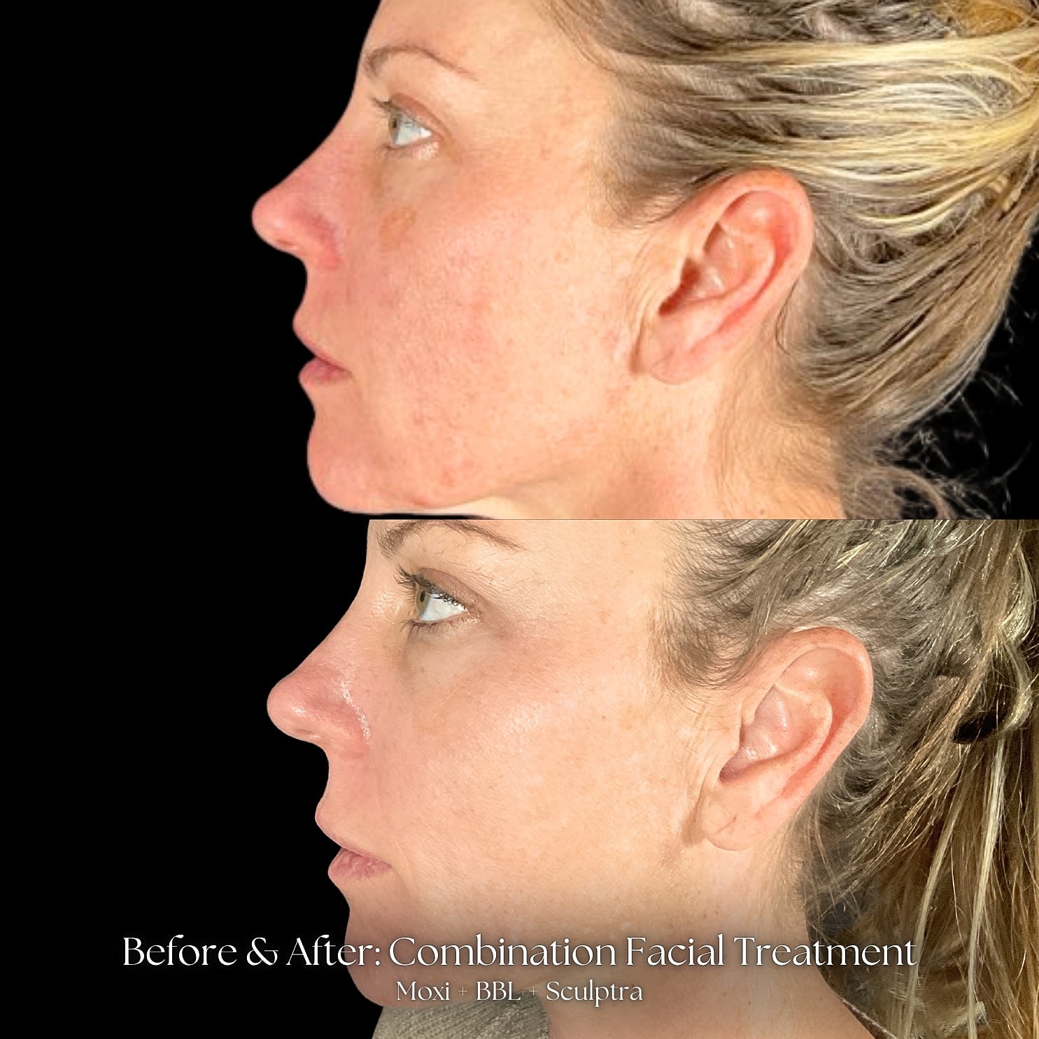 Sculptra Before & After