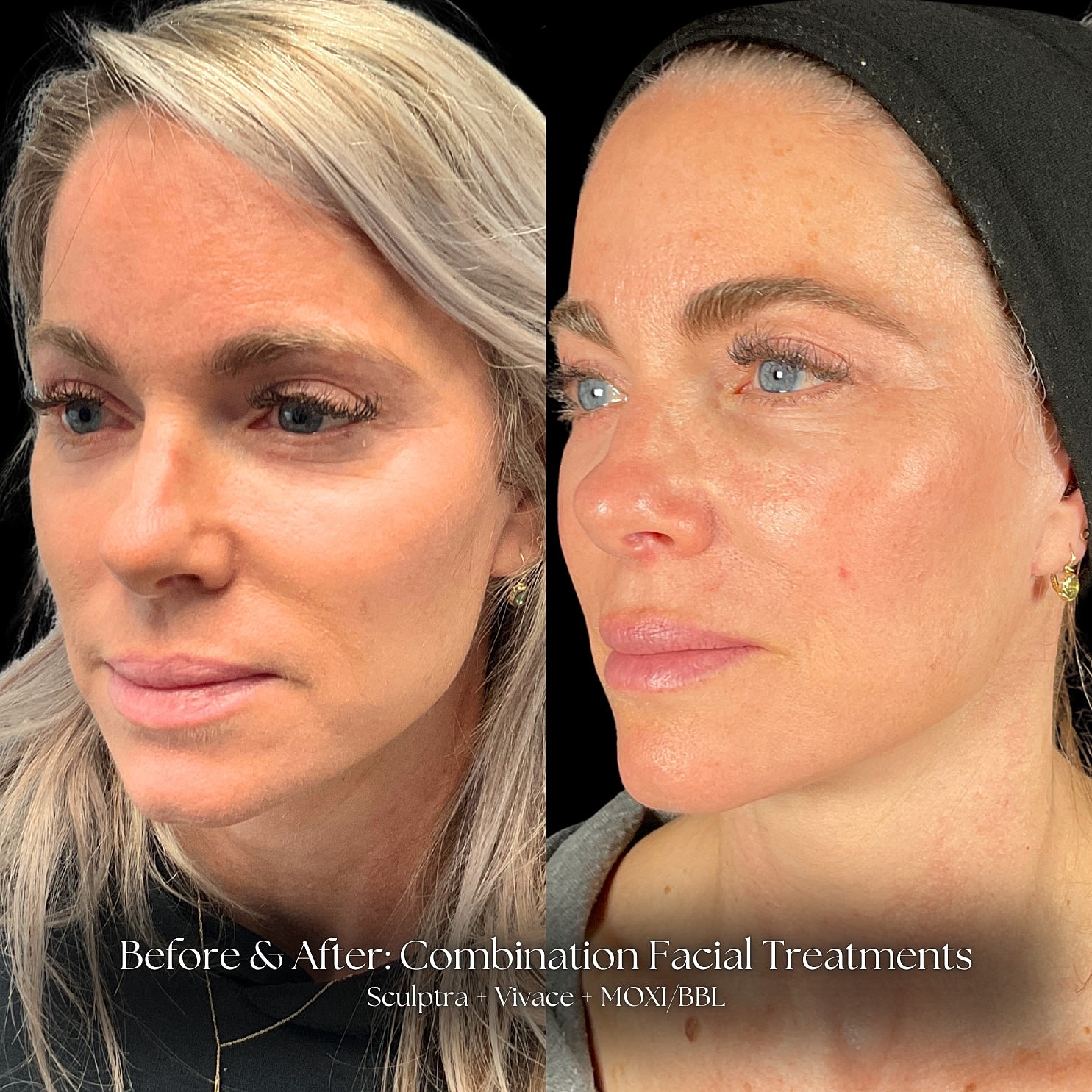 Sculptra Before & After