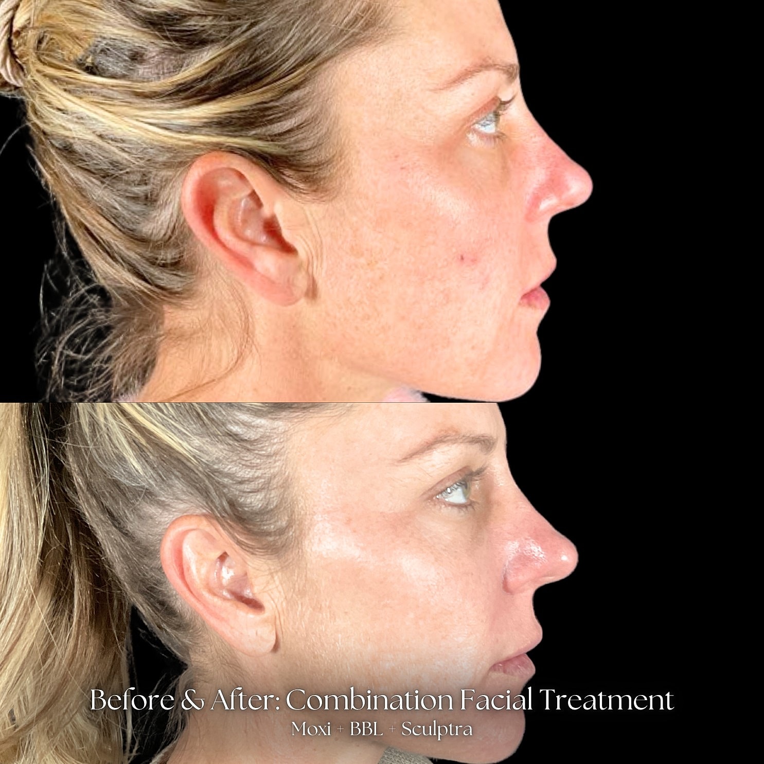 Laser Skin Resurfacing Before & After