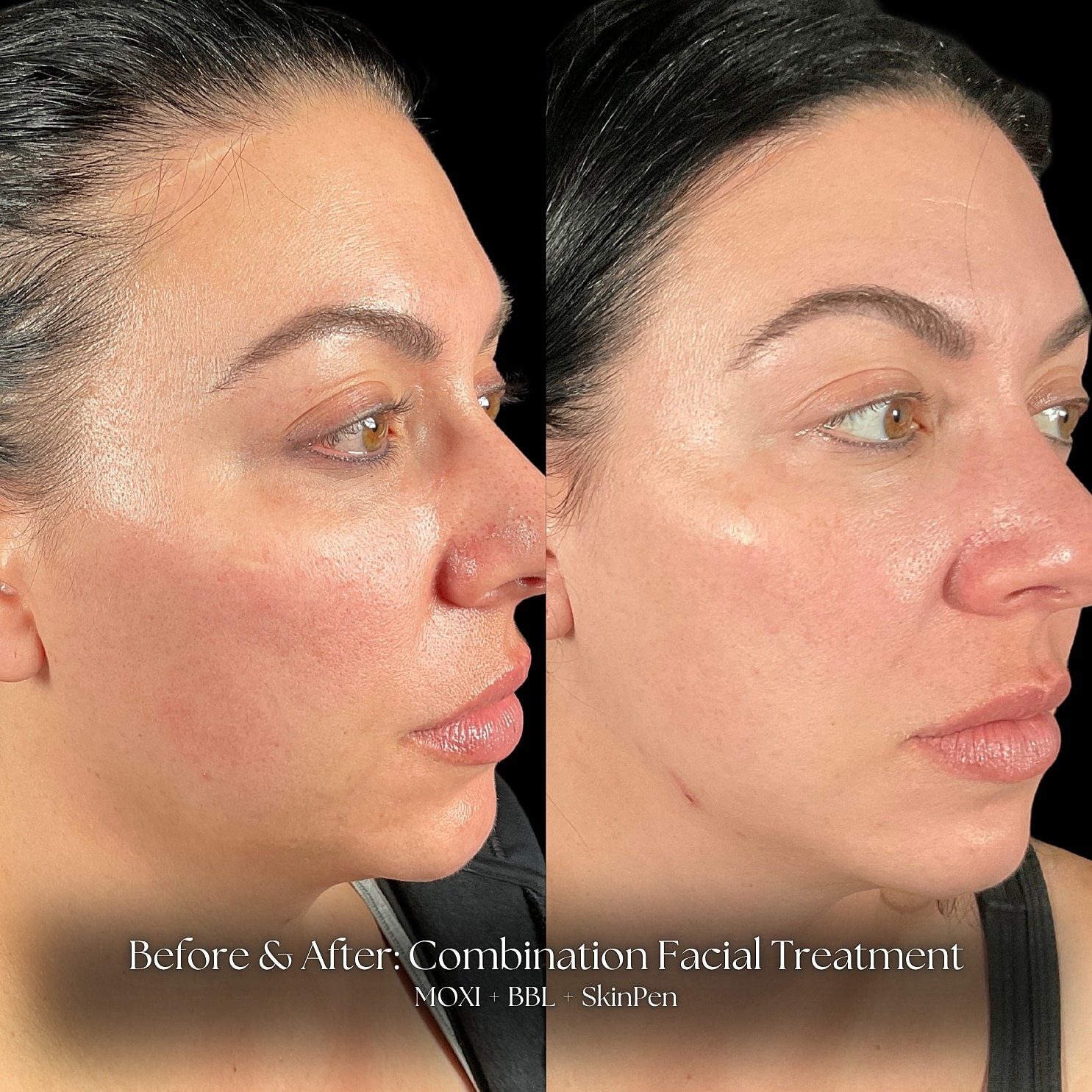 Laser Skin Resurfacing Before & After