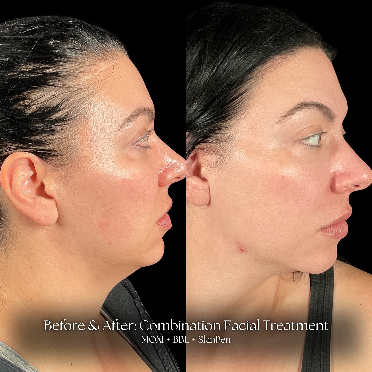 Laser Skin Resurfacing Before & After
