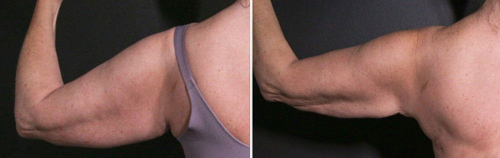 Upper Arm Rejuvenation Before & After