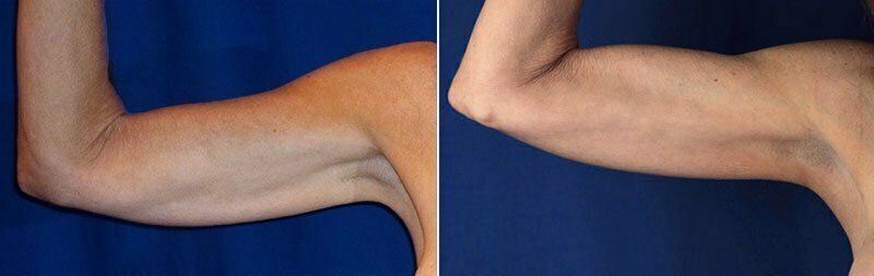Upper Arm Rejuvenation Before & After