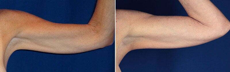 Upper Arm Rejuvenation Before & After