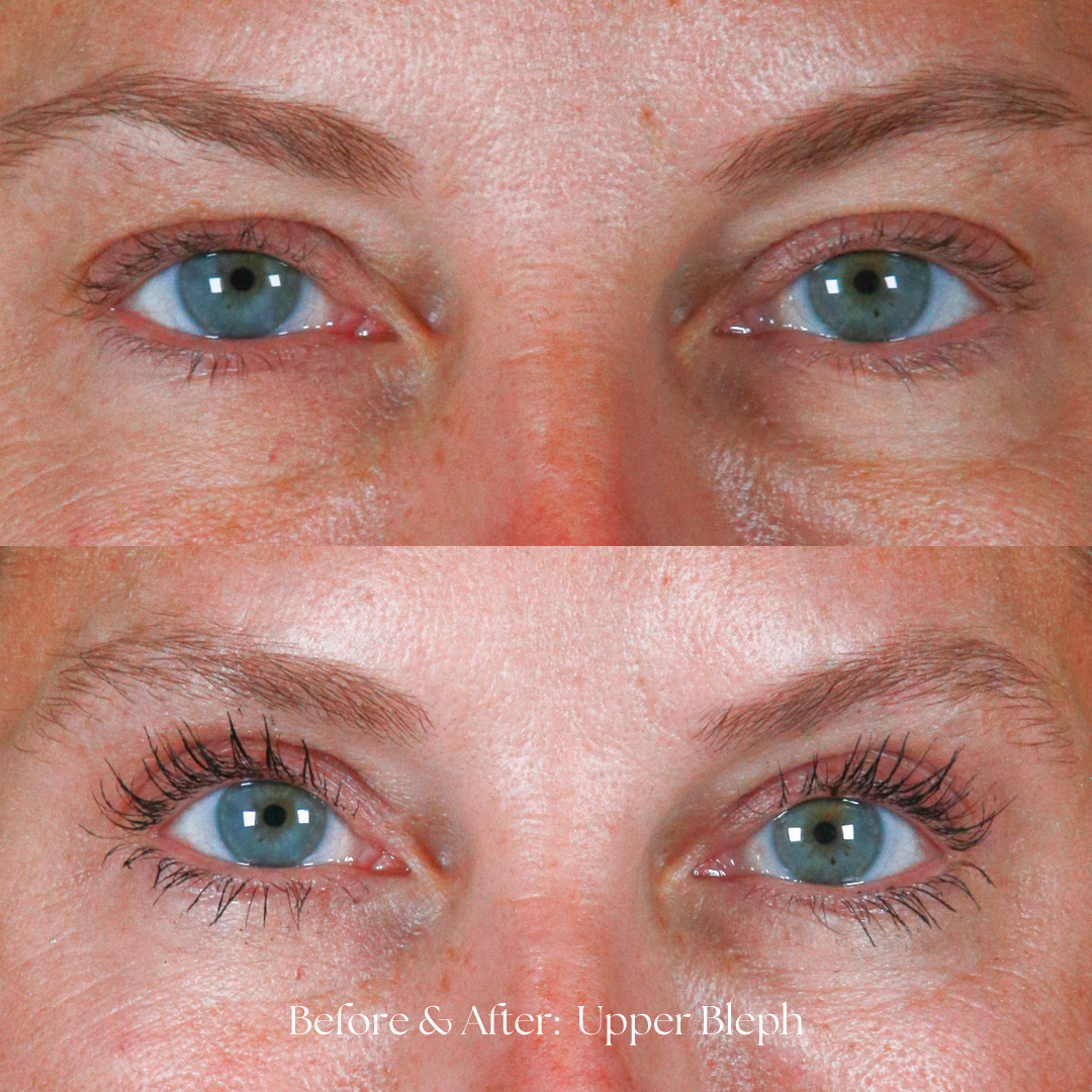 Eyelid Lift Before & After