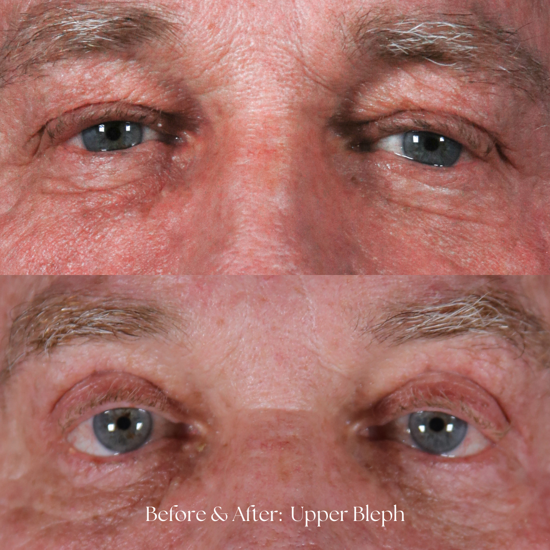 Eyelid Lift Before & After