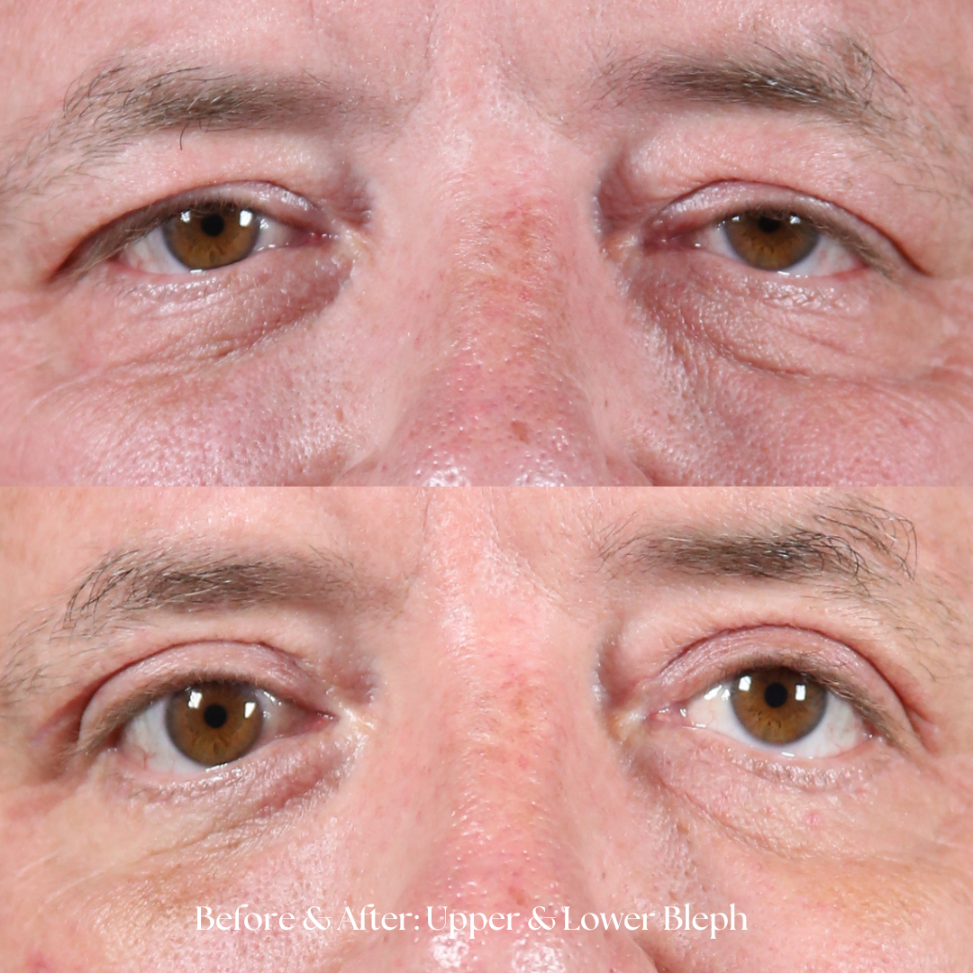 Eyelid Lift Before & After