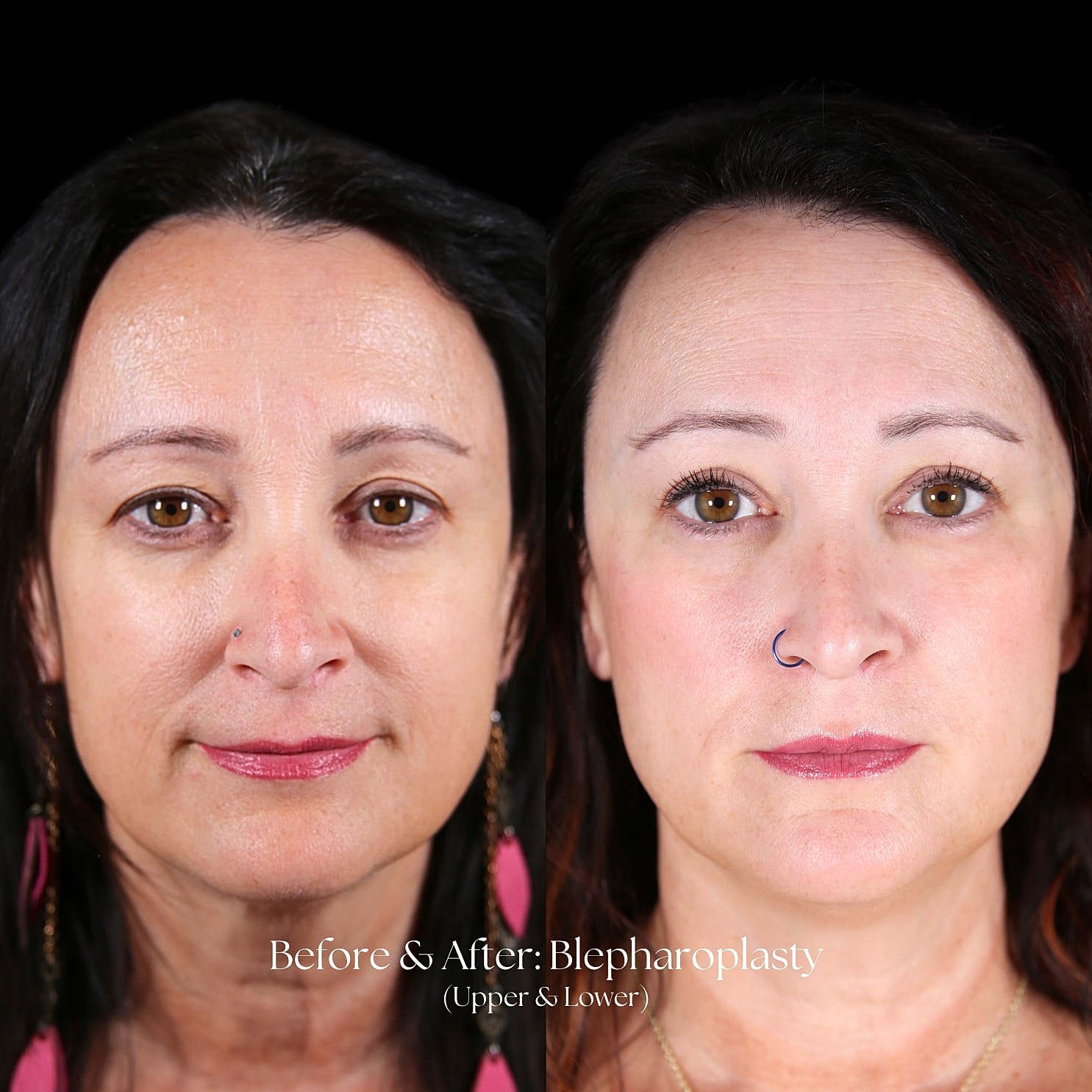 Eyelid Lift Before & After