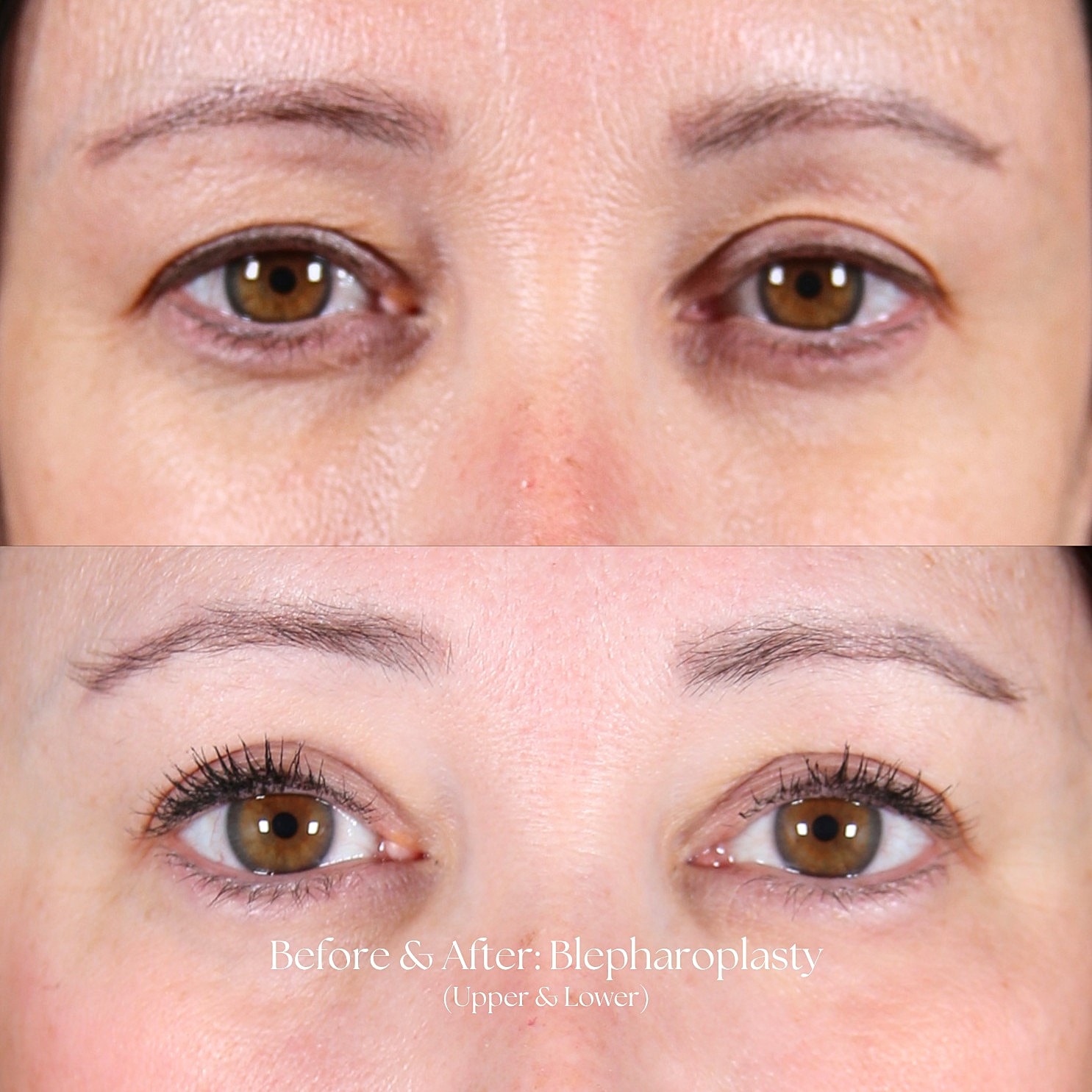 Eyelid Lift Before & After