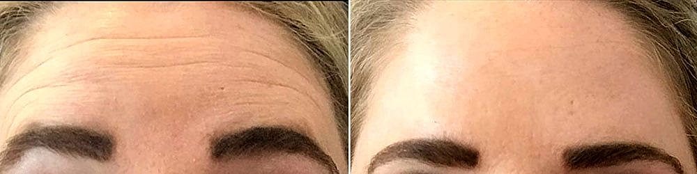 Botox Before & After