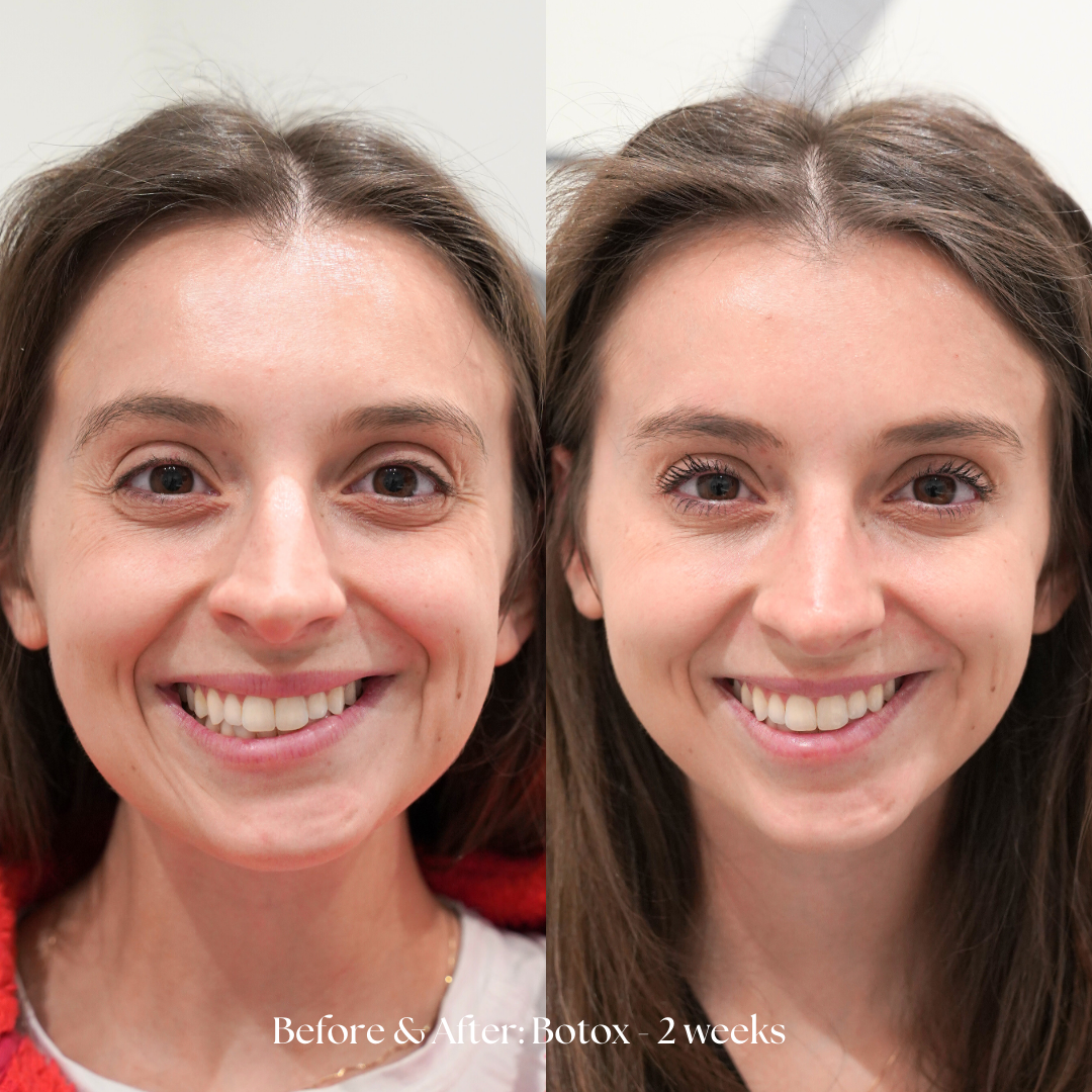 Botox Before & After