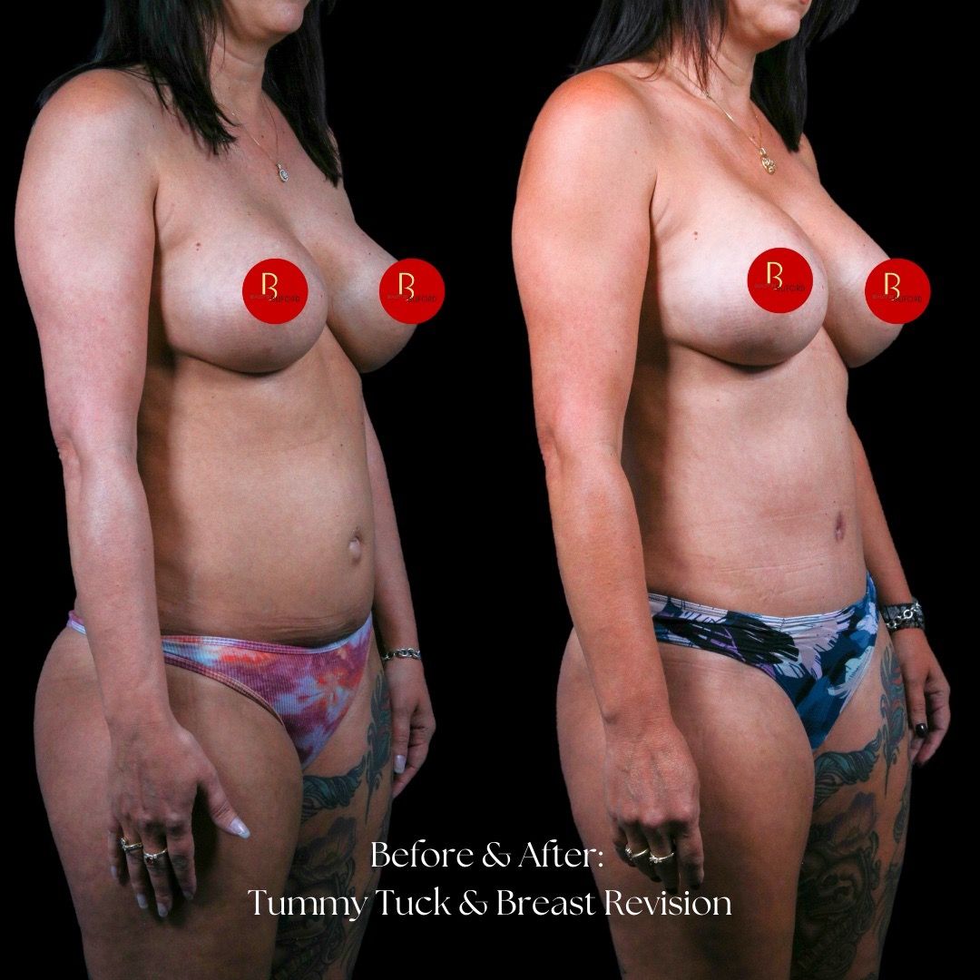 Breast Revision Before & After