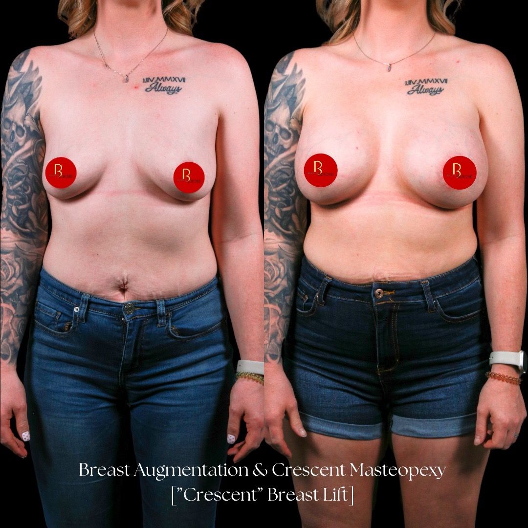 Breast Lift Before & After