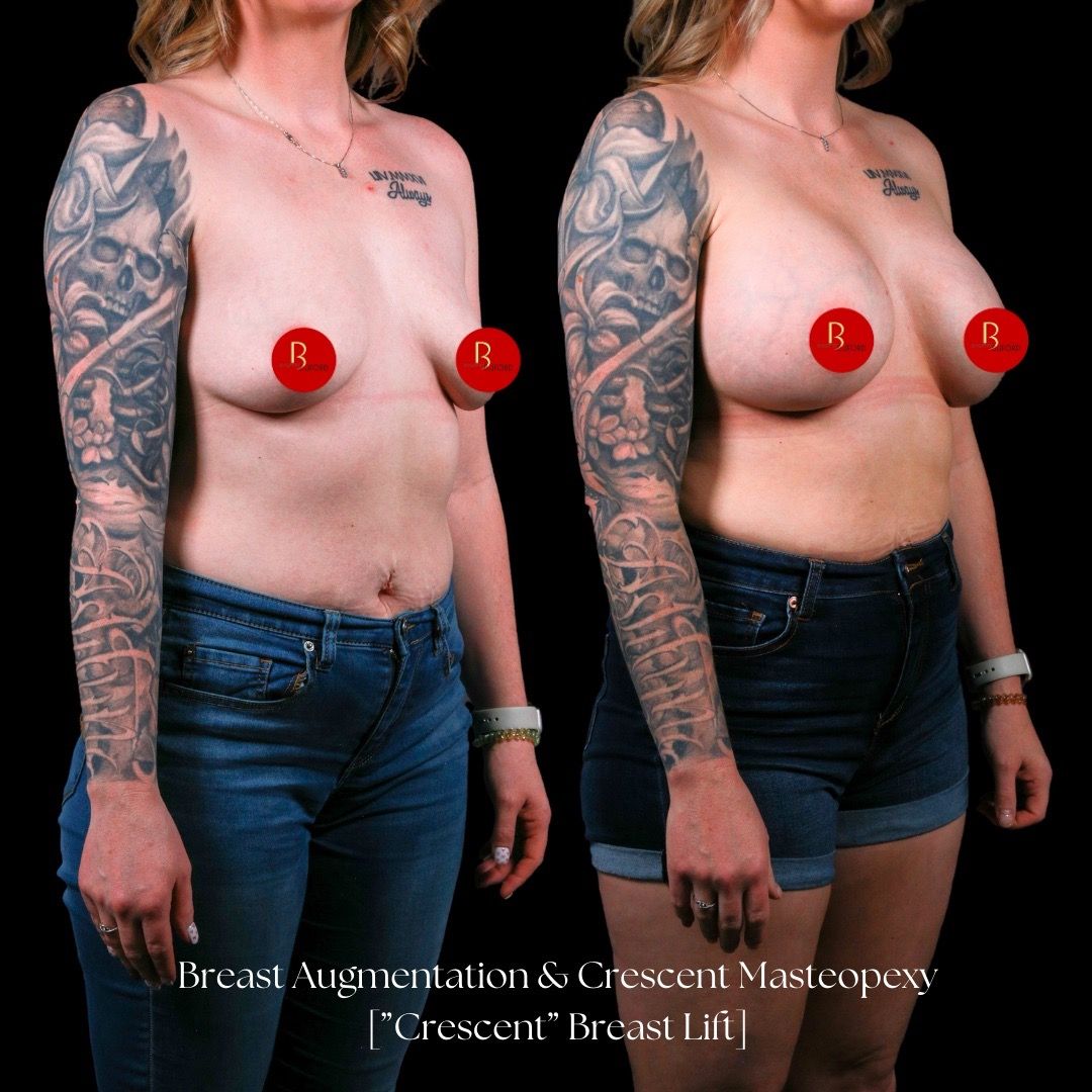 Breast Lift Before & After