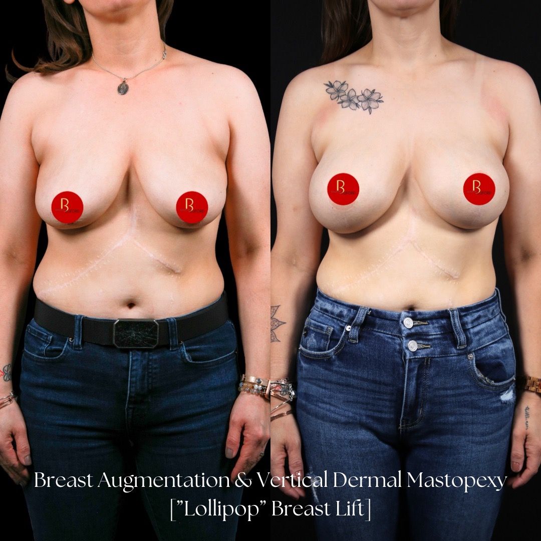 Breast Lift Before & After