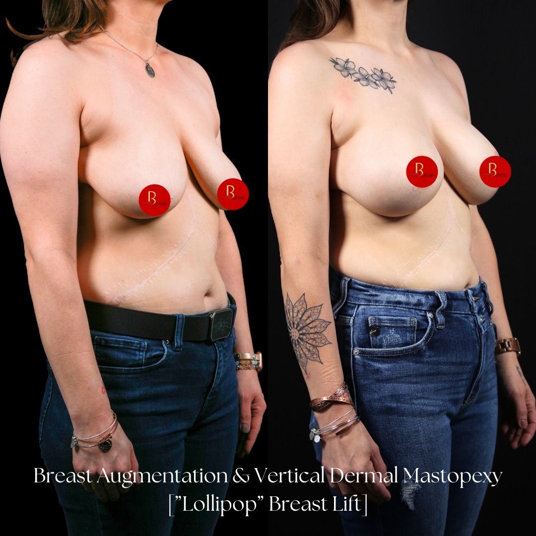 Breast Lift Before & After