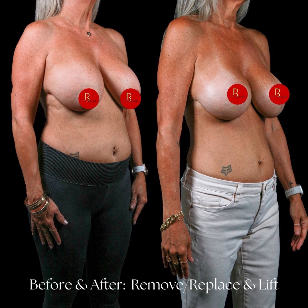 Breast Lift Before & After