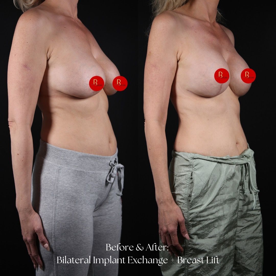 Breast Lift Before & After