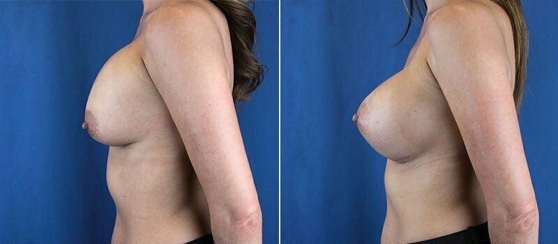 Secondary Revision Before & After