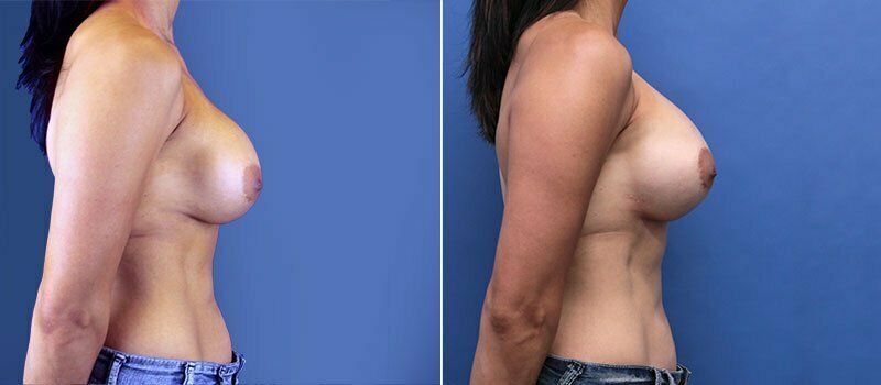 Secondary Revision Before & After