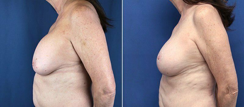 Secondary Revision Before & After