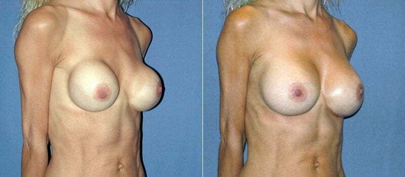 Secondary Revision Before & After