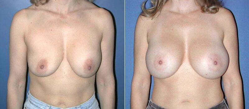 Secondary Revision Before & After