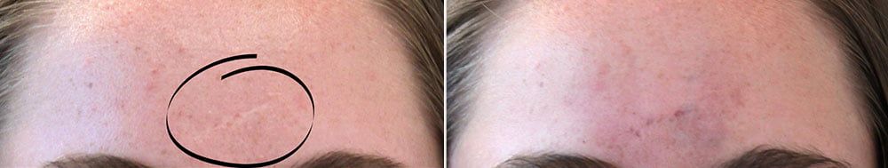 Scar Revision Before & After