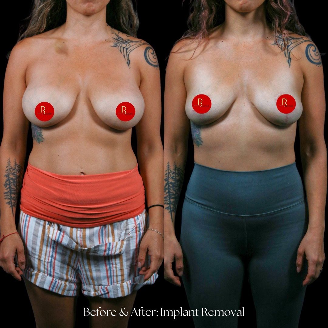 Implant Removal Before & After