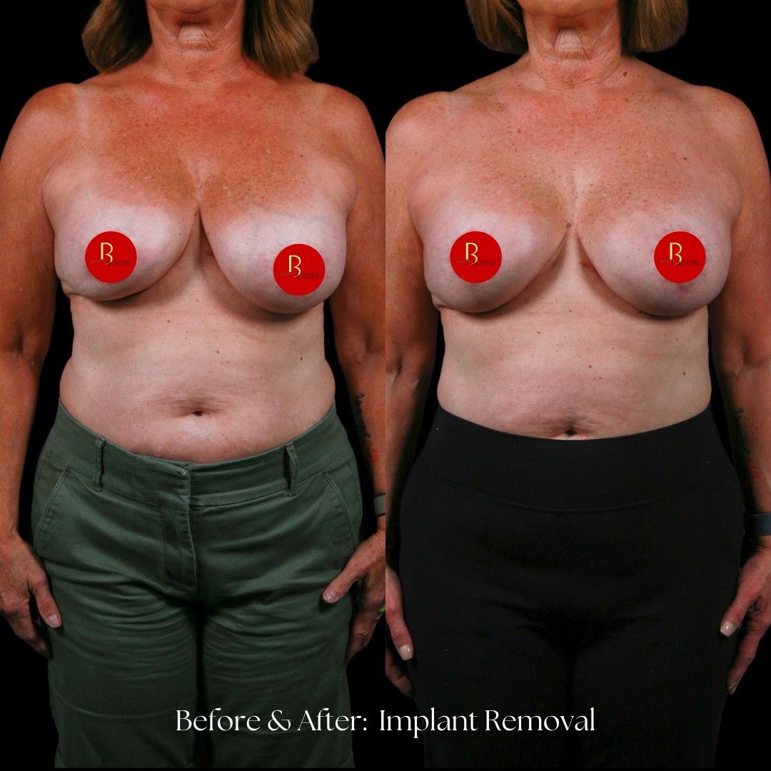 Implant Removal Before & After