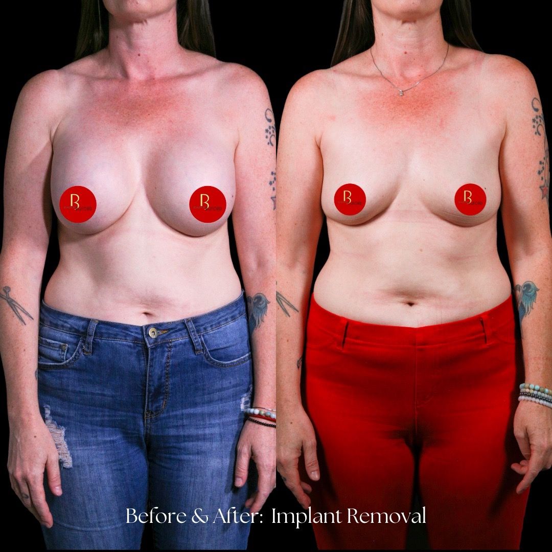 Implant Removal Before & After