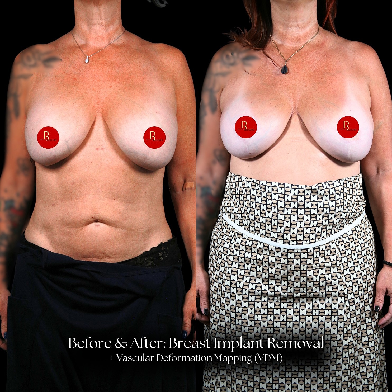 Implant Removal Before & After