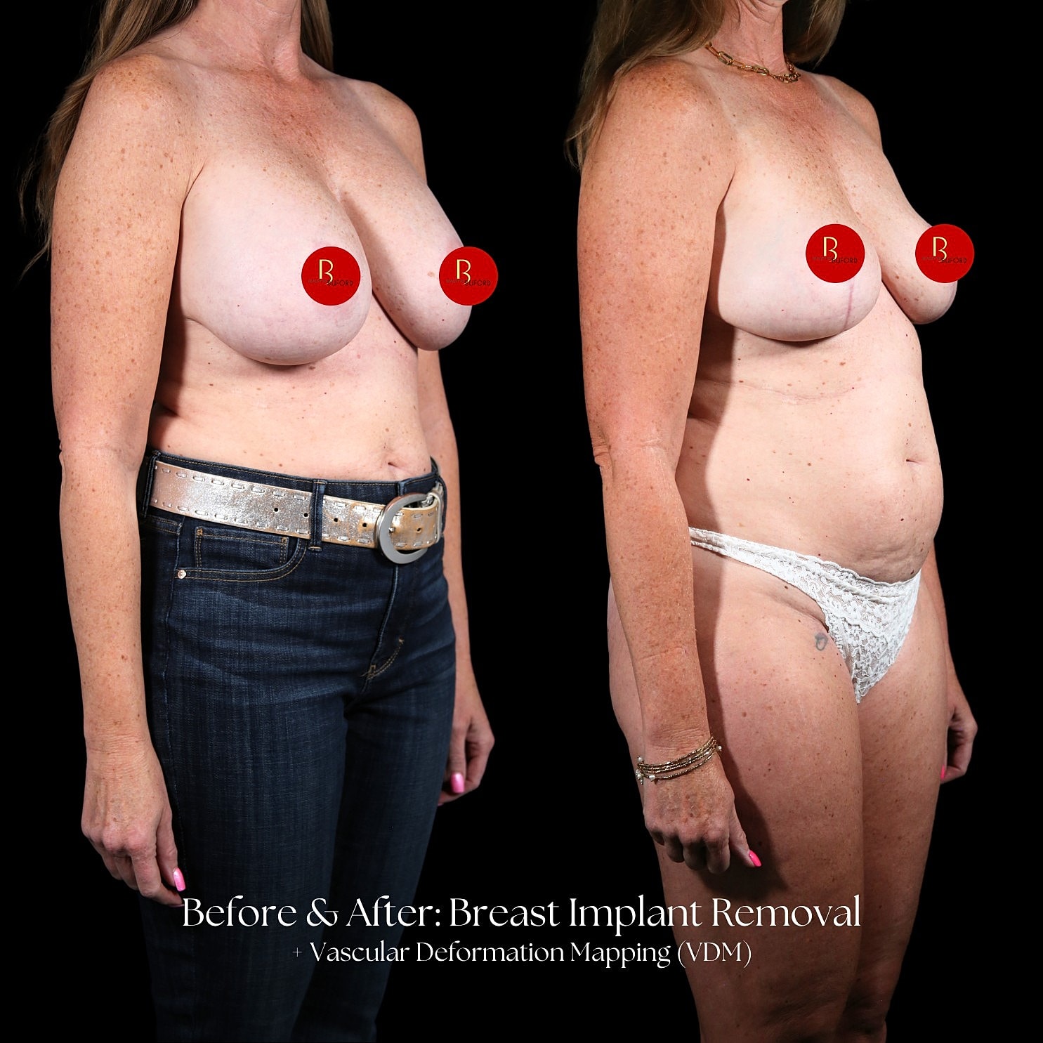 Implant Removal Before & After