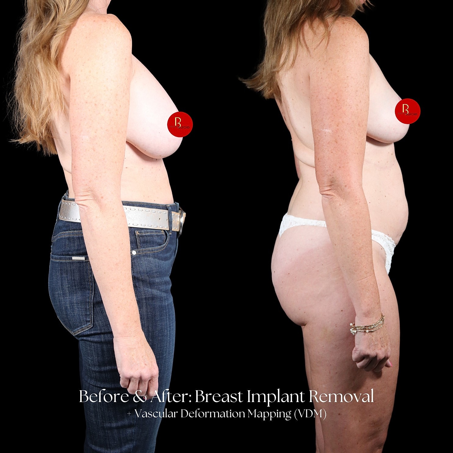 Implant Removal Before & After