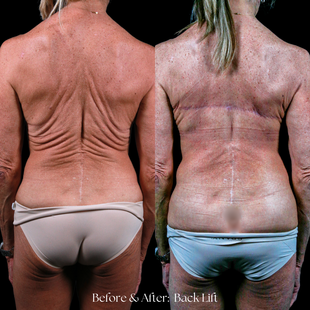 Back Lift Before & After