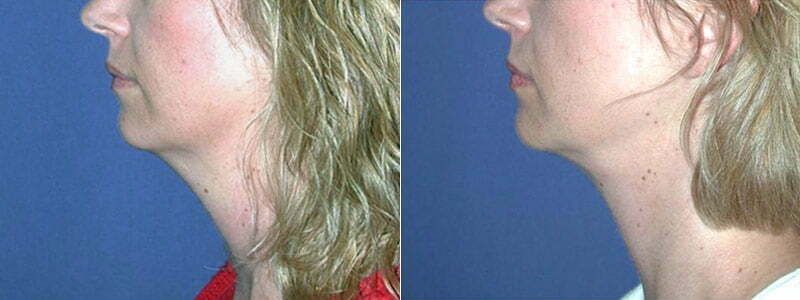 Neck Contouring Before & After
