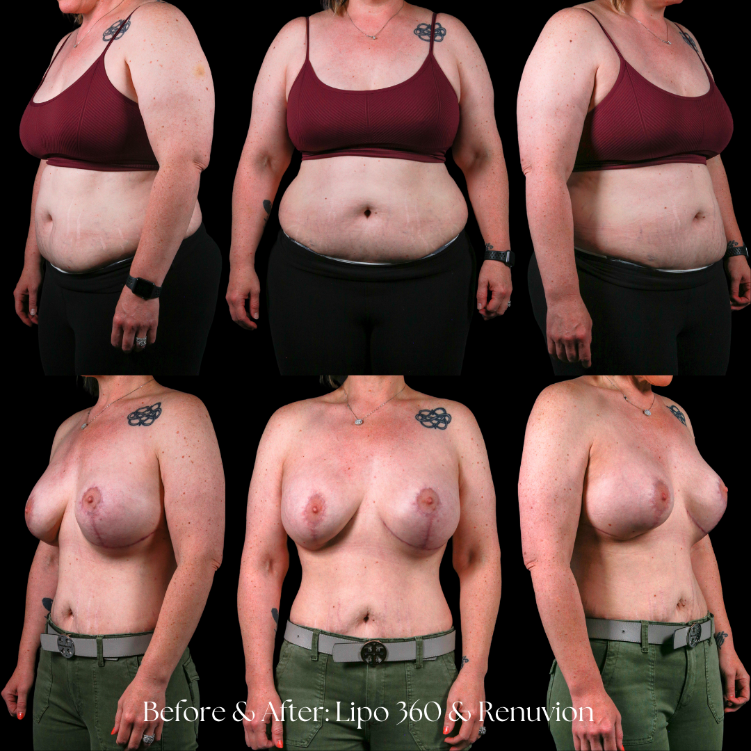 Liposuction  Before & After