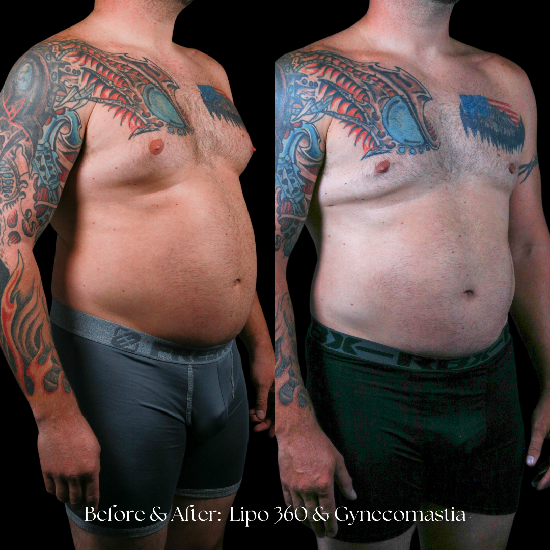 Liposuction  Before & After