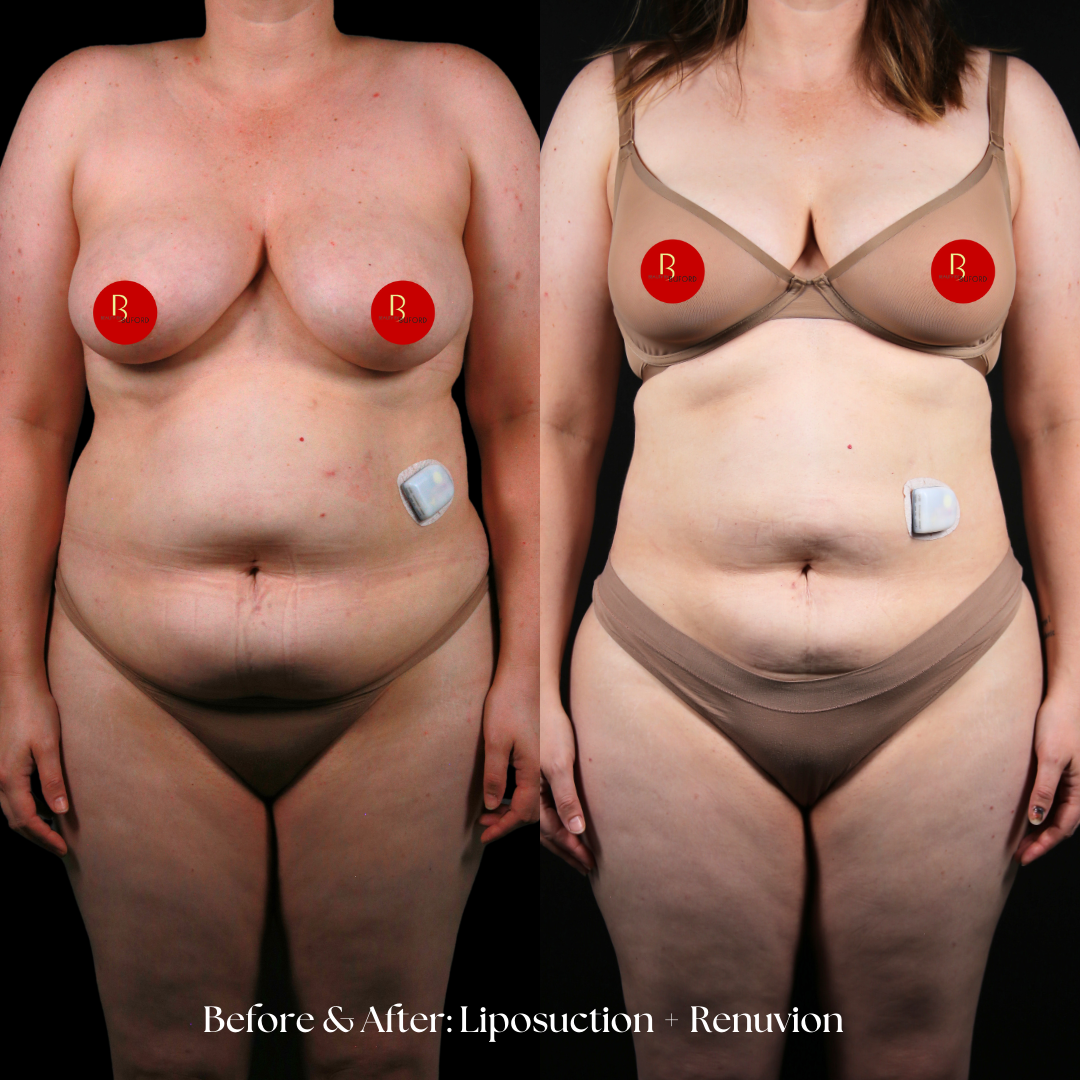 Liposuction  Before & After